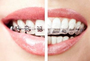 traditional braces v invisalign