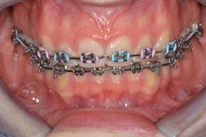 Six month braces